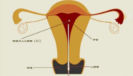 腹股沟管
