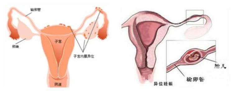 脑瘫儿
