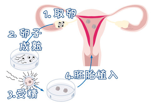 自然流产