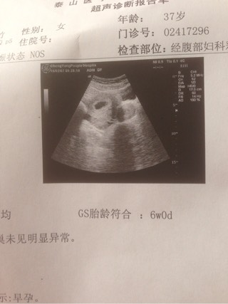 自然受孕双胞胎